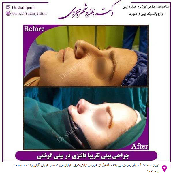 جراحی بینی گوشتی - دکتر مجتبی سهراب پور