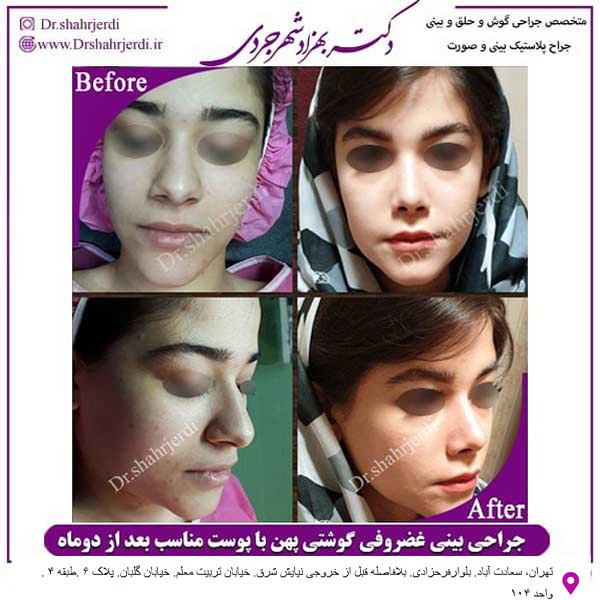 جراحی بینی گوشتی - دکتر مجتبی سهراب پور