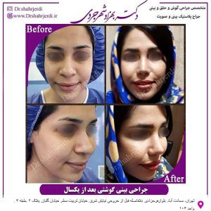 جراحی پلاستیک بینی - دکتر بهزاد شهرجردی