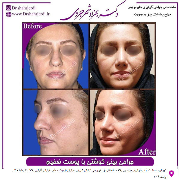 جراحی بینی گوشتی - دکتر مجتبی سهراب پور