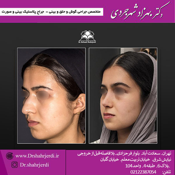 جراحی پلاستیک بینی - دکتر بهزاد شهرجردی