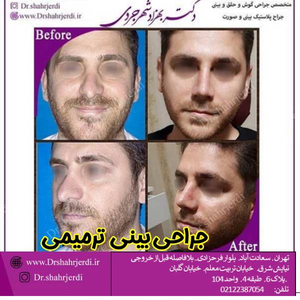 عکس نمونه کار جراحی بینی ترمیمی - دکتر بهزاد شهرجردی