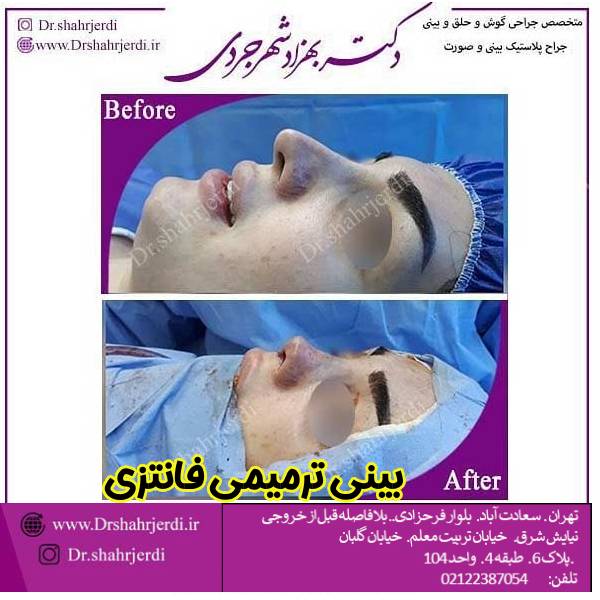 عکس جراحی بینی ترمیمی در تهران - دکتر بهزاد شهرجردی