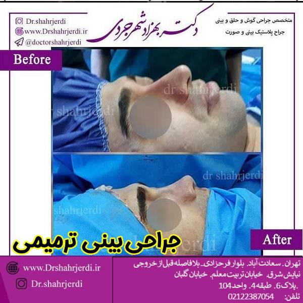 عکس نمونه کار جراحی بینی ترمیمی - دکتر بهزاد شهرجردی