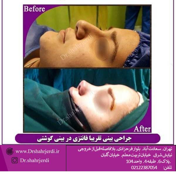 عکس جراحی بینی نیمه فانتزی