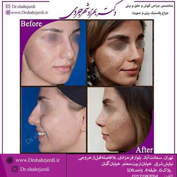 جراحی بینی فانتزی