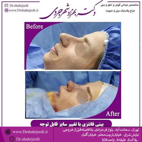 عکس جراحی بینی فانتزی - دکتر بهزاد شهرجردی