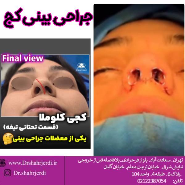 جراحی بینی کج