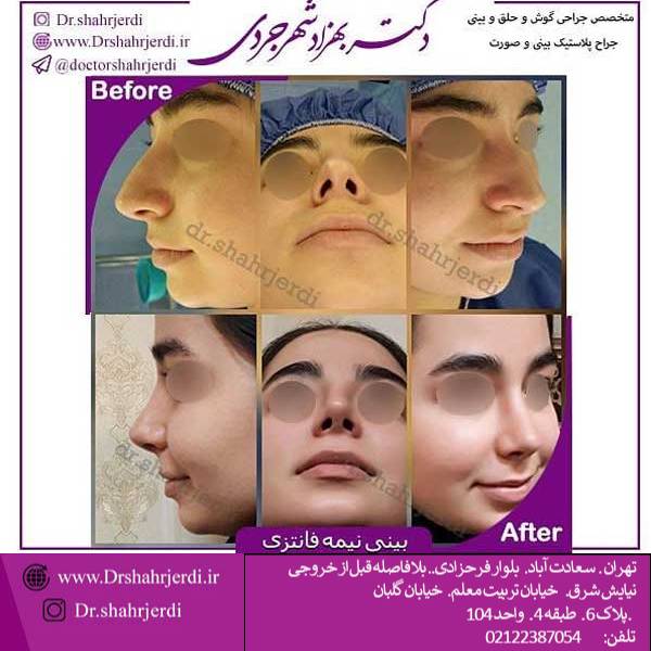 عکس جراحی بینی نیمه فانتزی
