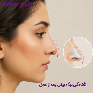 افتادگی نوک بینی بعد از عمل - ئکتر شهرجردی