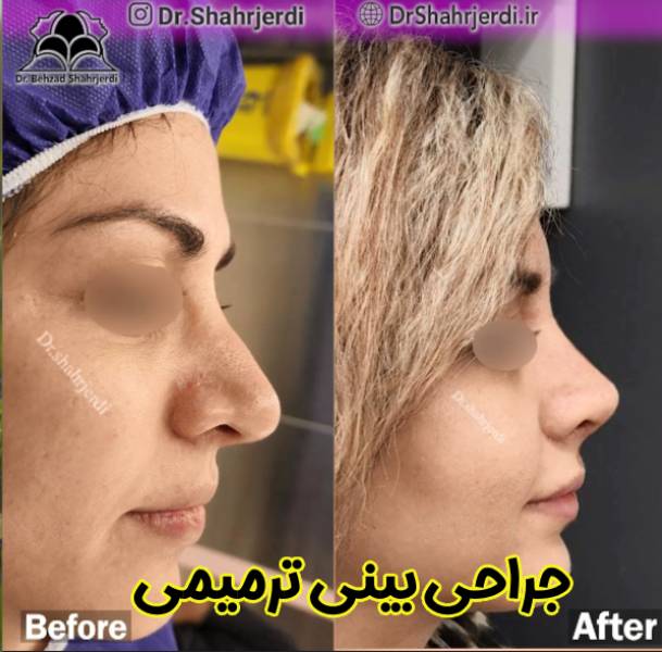 عکس نمونه کار جراحی بینی ترمیمی - دکتر بهزاد شهرجردی