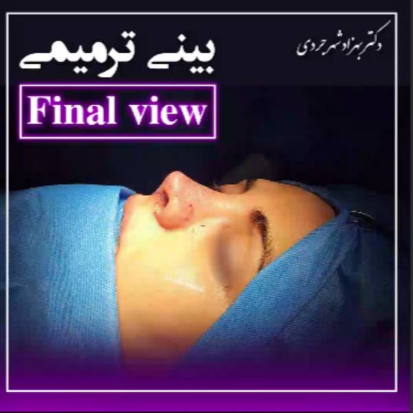 عکس نمونه کار جراحی بینی ترمیمی - دکتر بهزاد شهرجردی