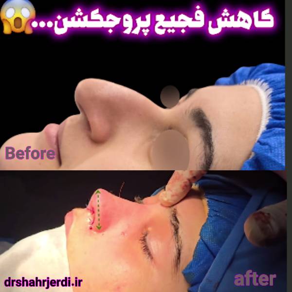 نتیجه کاهش پروجکشن و درازی بینی توسط دکتر بهزاد شهرجردی - قبل و بعد