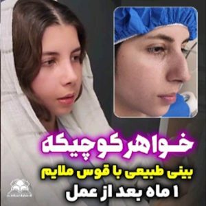 جراحی بینی - دکتر بهزاد شهرجردی