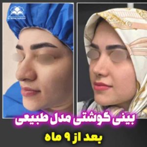 جراحی بینی - دکتر بهزاد شهرجردی