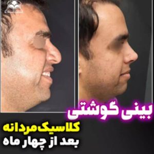 جراحی بینی - دکتر بهزاد شهرجردی