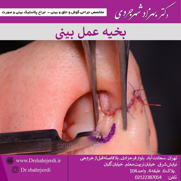 بخیه عمل بینی