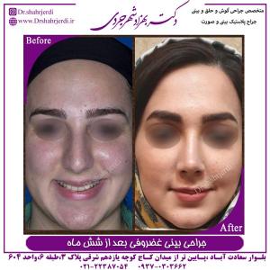 جراحی بینی غضروفی 15