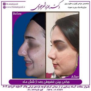 جراحی بینی غضروفی 2 (1)