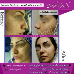 عمل جراحی بینی - دکتر شهرجردی (11)