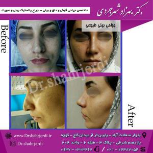 عمل جراحی بینی - دکتر شهرجردی (4)