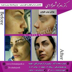 عمل جراحی بینی - دکتر شهرجردی (6)